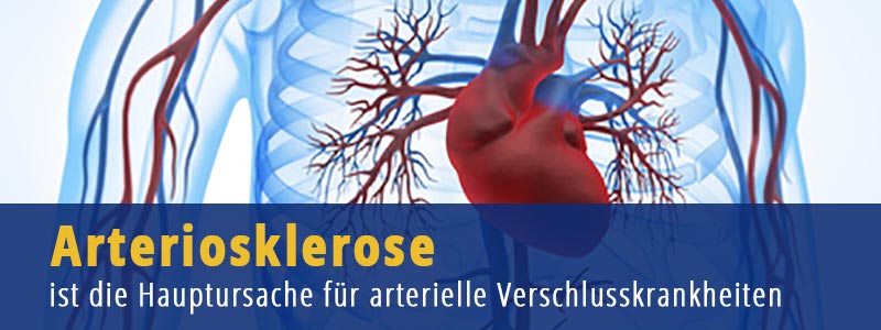 Arteriosklerose